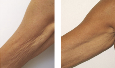SmoothBelow Cryo-Thermo Gold Gel