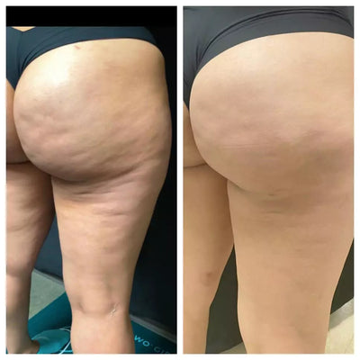 SmoothBelow Cryo-Thermo Gold Gel