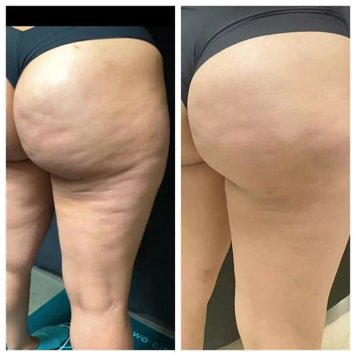 SmoothBelow Cryo-Thermo Gold Gel