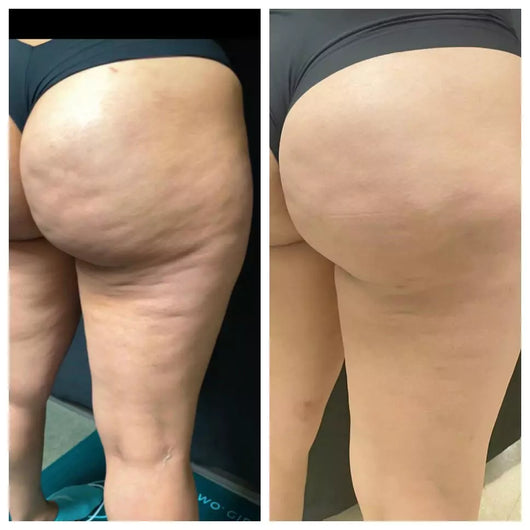 SmoothBelow Cryo-Thermo Gold Gel