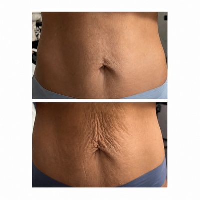 SmoothBelow Cryo-Thermo Gold Gel